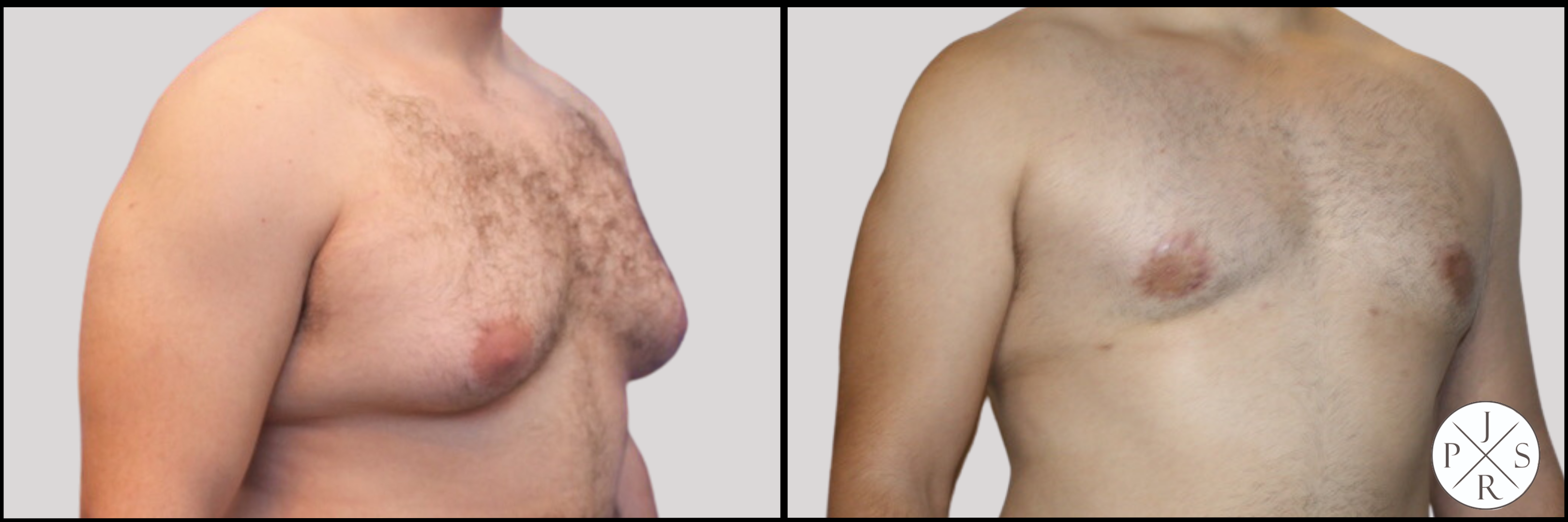 Gynecomastia Before & After Image